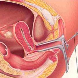 Procedura inseminarii artificiale