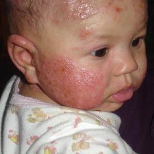 alergie bebelus iritatie fata (http://rhemashope.files.wordpress.com)