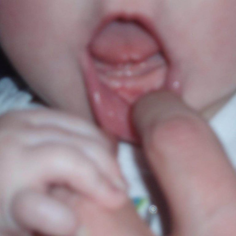 Simptomele eruptiei dentare