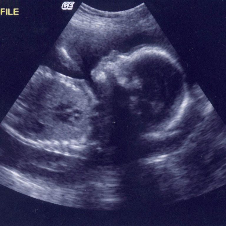 Copiii pot auzi zgomotul produs de ecografie in timpul sarcinii