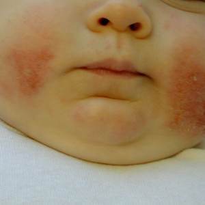 eczema la copil (www.esanatos.com)