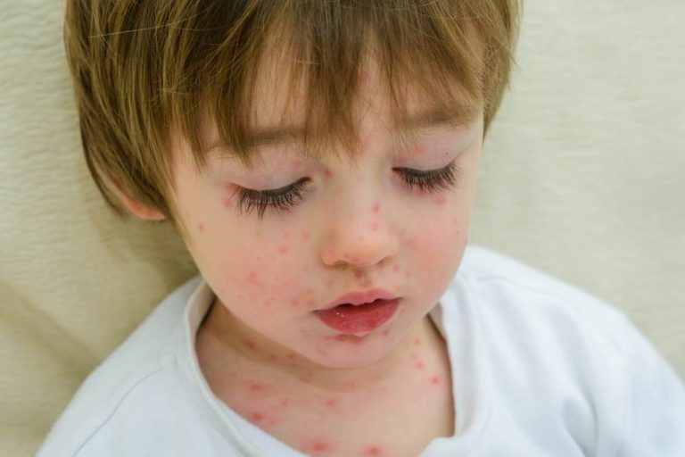 Ministerul Sanatatii a declarat EPIDEMIE de rujeola, dupa moartea a 3 copii. Cauza oficiala: campaniile anti-vaccinare