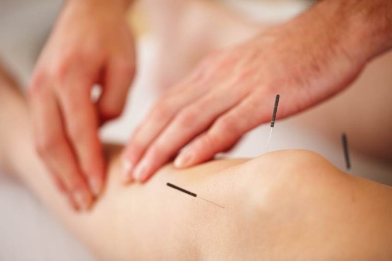 Acupunctura, tratamentul alternativ al gonartrozei