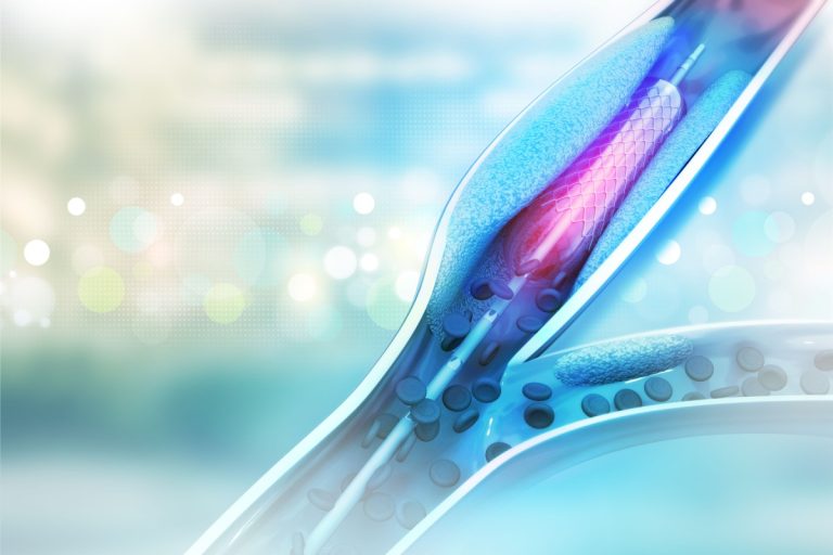 Ce presupune angioplastia coronariană cu stent și când este recomandată?