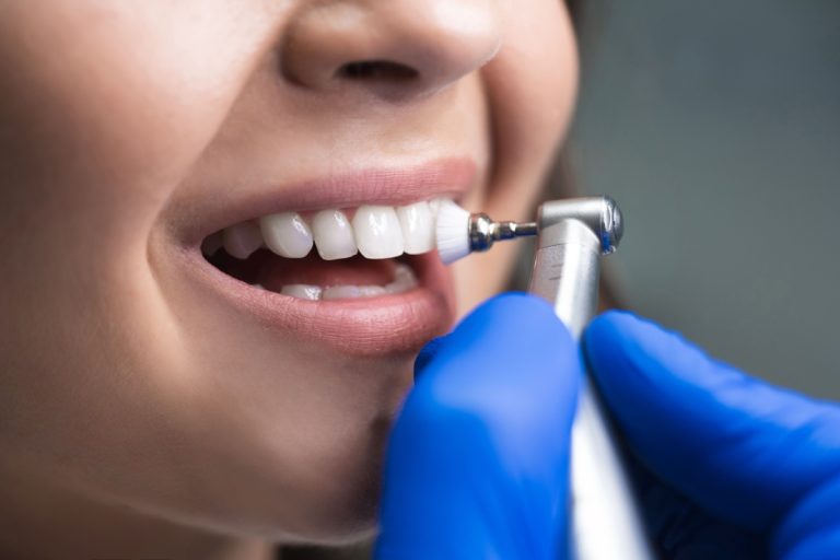Ghid complet pentru îngrijirea dinților după aplicarea fațetelor dentare