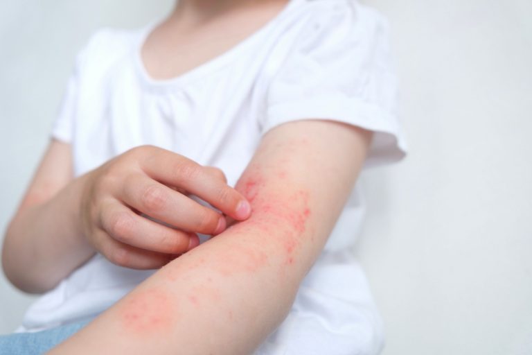 Ce trebuie să știi despre dermatita atopică și cum să o gestionezi?