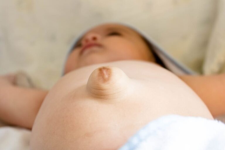 Hernia ombilicală la bebeluși: când trebuie intervenit? 